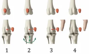 دررفتگی کشکک یا لغزش کاسه زانو در سگها